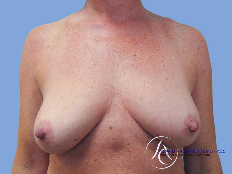 Breast lift before & after photo